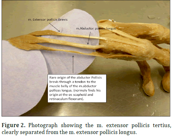 anatomical-variations-extensor-pollicis