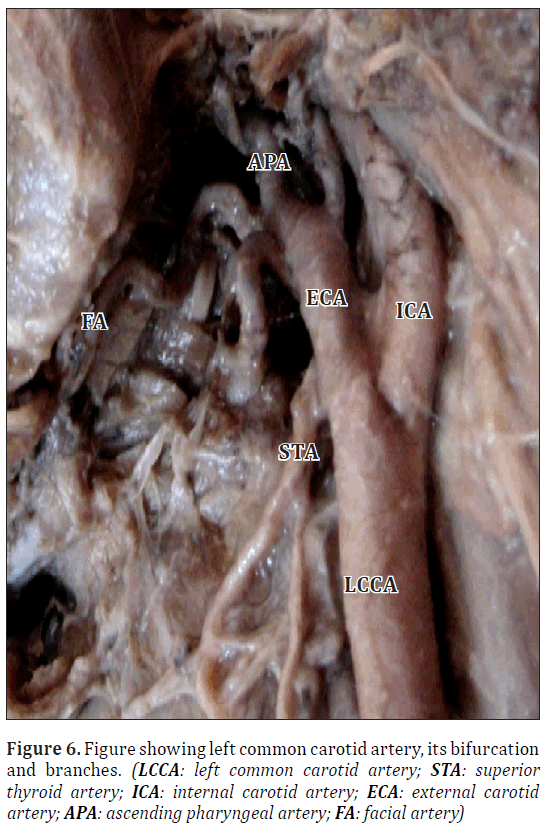 anatomical-variations-external-carotid