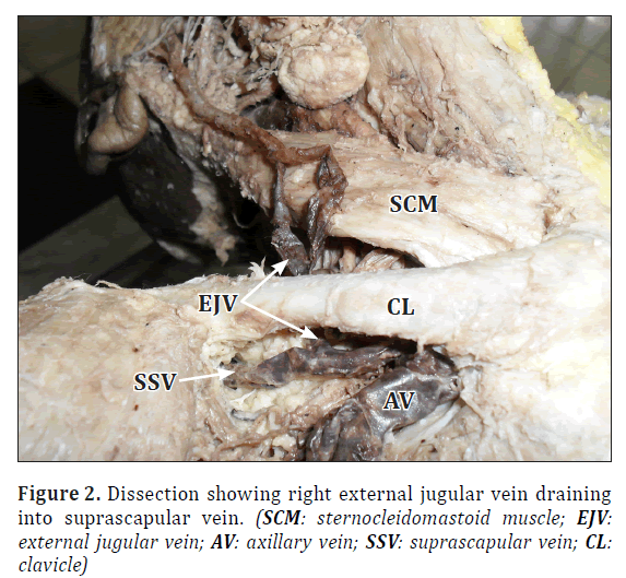 anatomical-variations-external-jugular