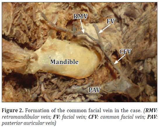 anatomical-variations-facial-vein