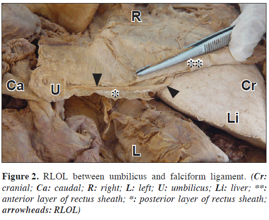 anatomical-variations-falciform-ligament