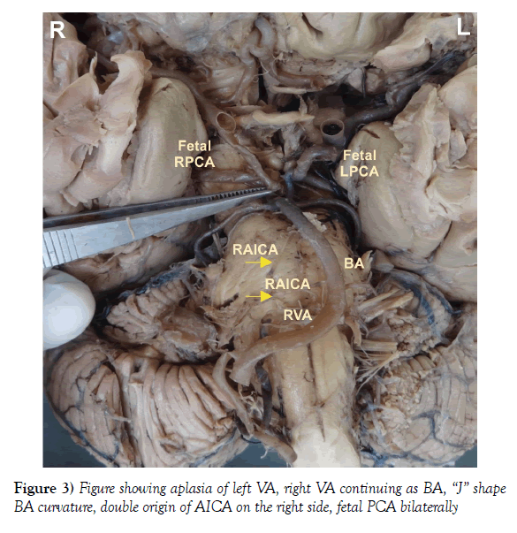 anatomical-variations-fetal-PCA