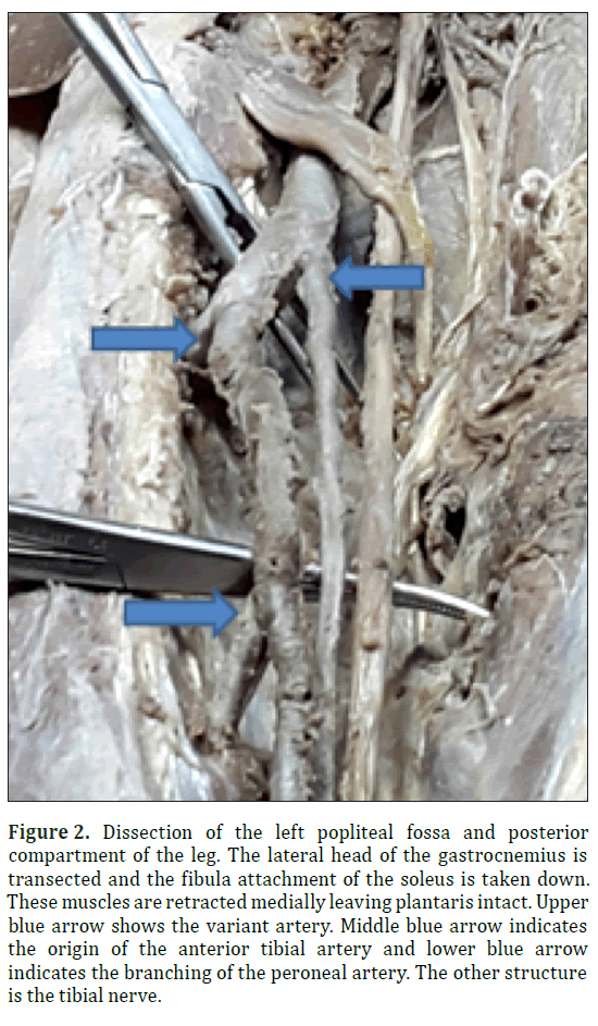 anatomical-variations-fibula-attachment