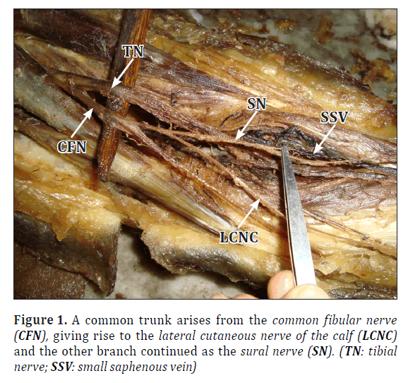 anatomical-variations-fibular-nerve