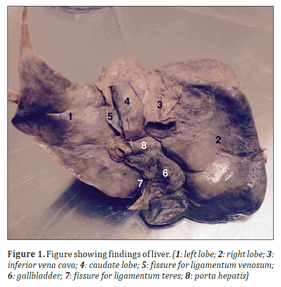 anatomical-variations-findings-liver