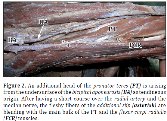 anatomical-variations-fleshy-fibers