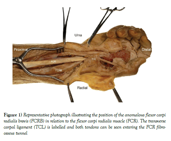 anatomical-variations-flexor-carpi