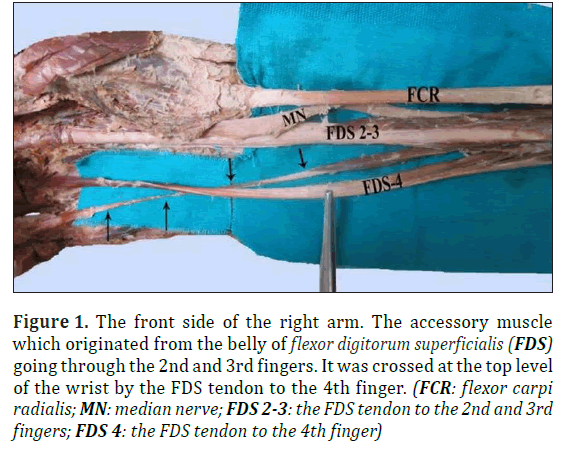 anatomical-variations-flexor-digitorum