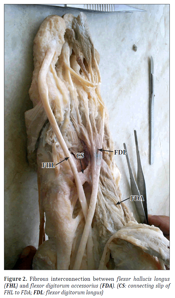 anatomical-variations-flexor-hallucis