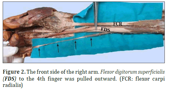 anatomical-variations-flexor-radialis
