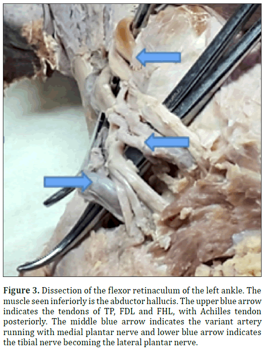 anatomical-variations-flexor-retinaculum