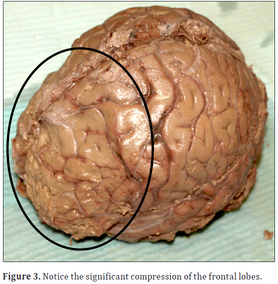 anatomical-variations-frontal