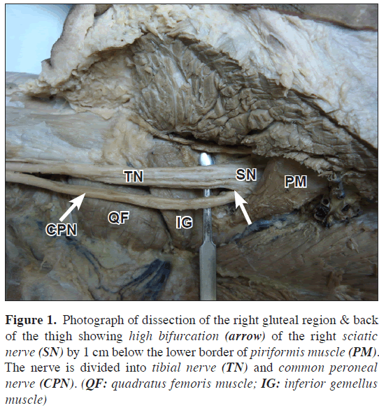 anatomical-variations-gluteal