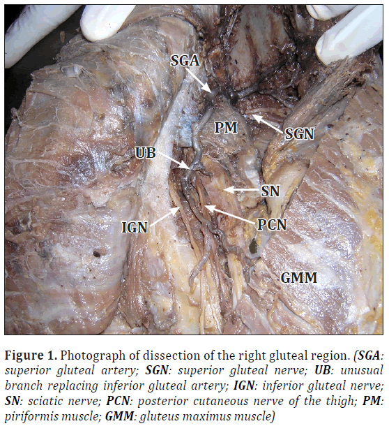 anatomical-variations-gluteal-region
