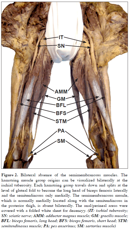 anatomical-variations-hamstring-muscle