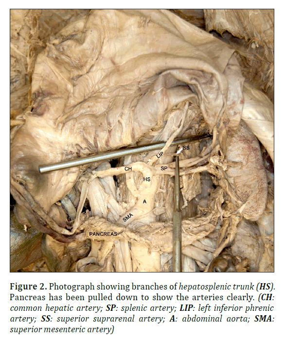 anatomical-variations-hepatosplenic-trunk
