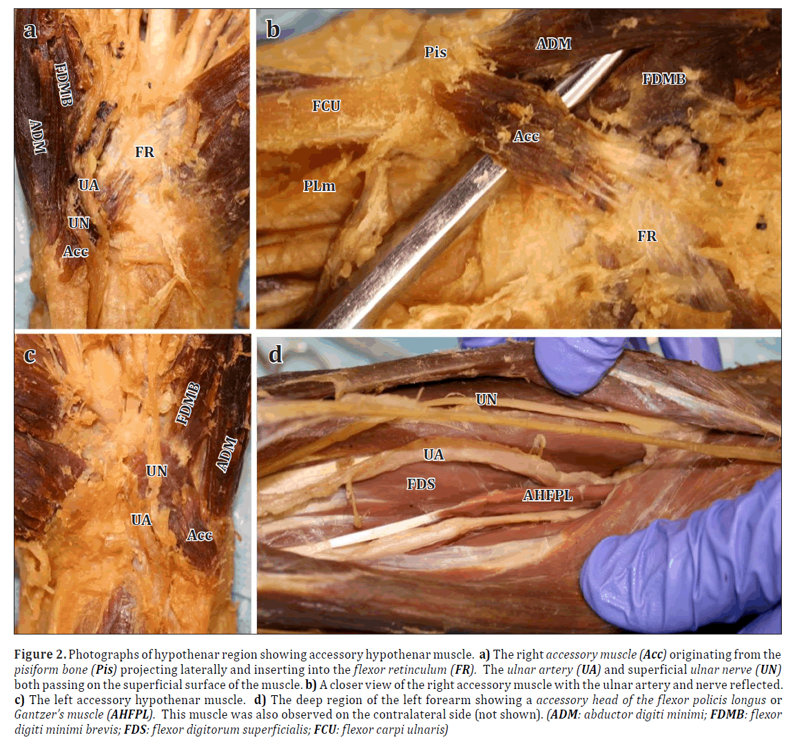 anatomical-variations-hypothenar-muscle