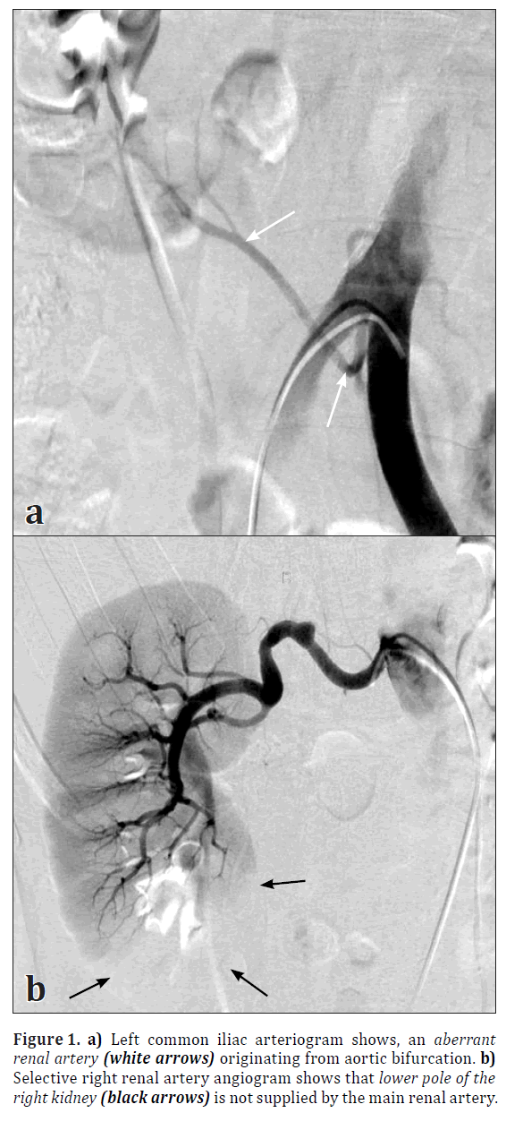 anatomical-variations-iliac-arteriogram