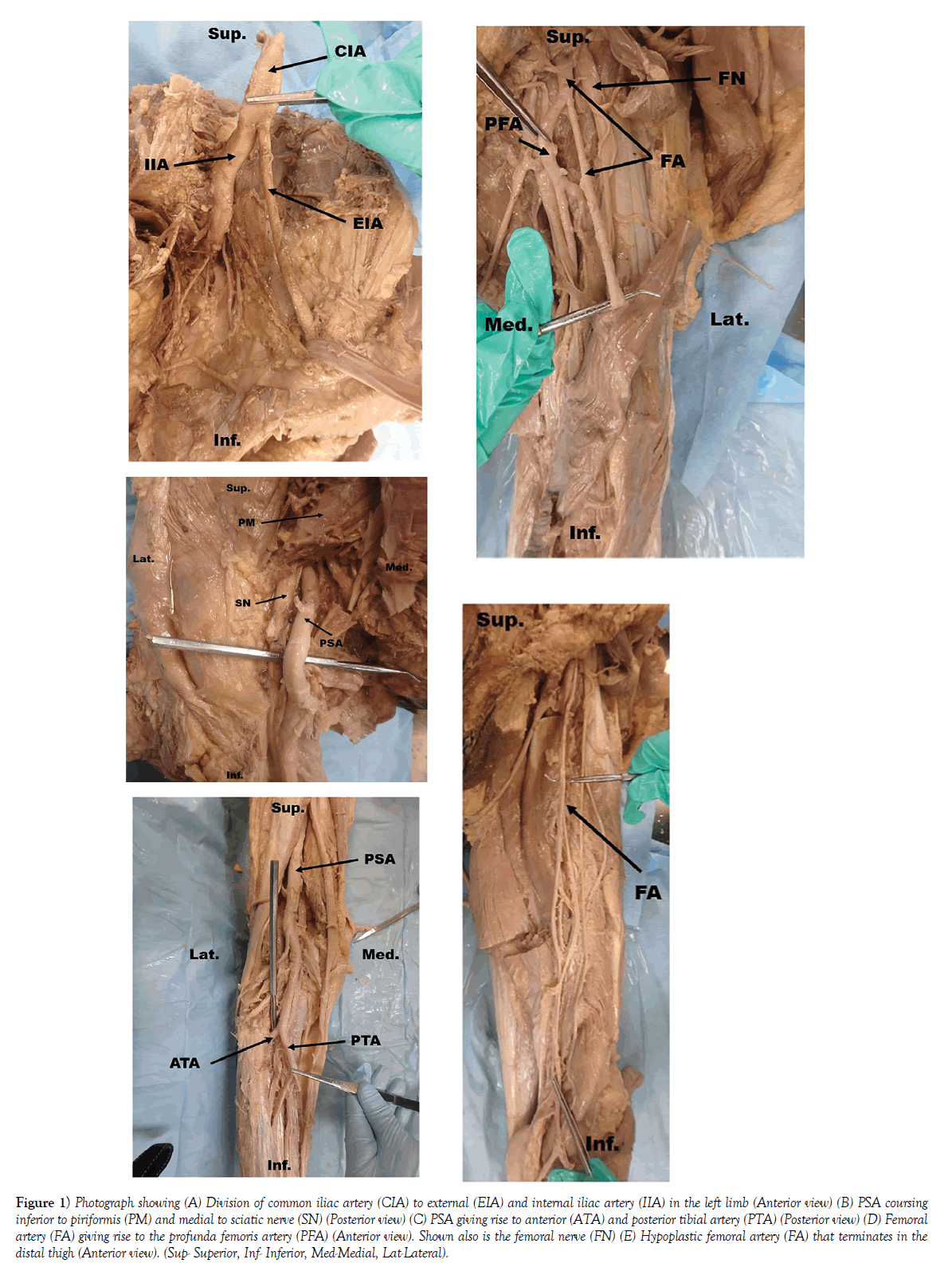 anatomical-variations-iliac-artery