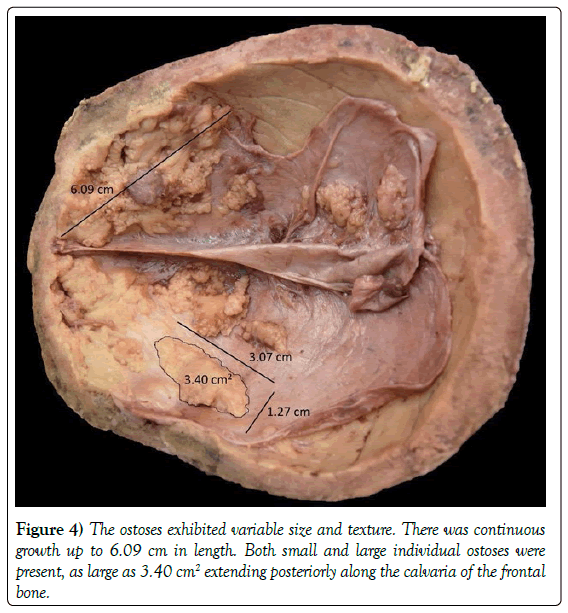 anatomical-variations-individual-ostoses