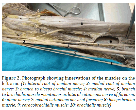 Bilateral absence of musculocutaneous nerve with unusual communicating