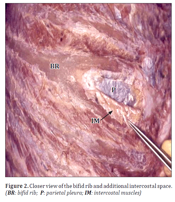 anatomical-variations-intercostal-space