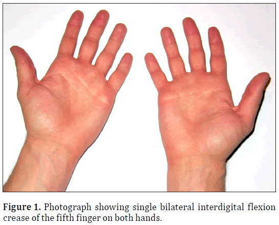 anatomical-variations-interdigital-flexion