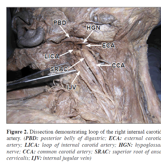 anatomical-variations-jugular-vein