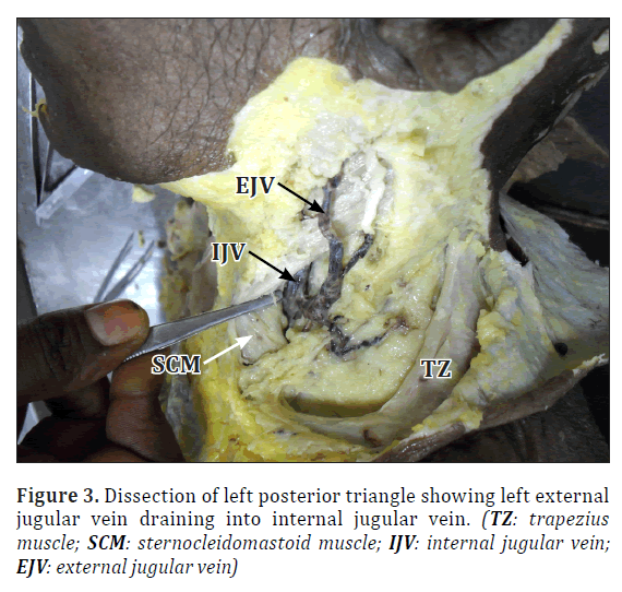 External Jugular Vein Passing Through Triangle Formed By