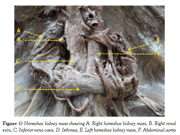 anatomical-variations-kidney-mass