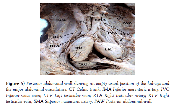 anatomical-variations-kidneys-pole