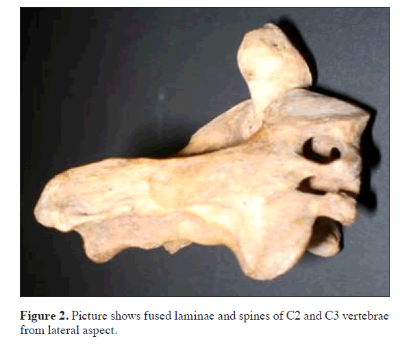 anatomical-variations-laminae-spines