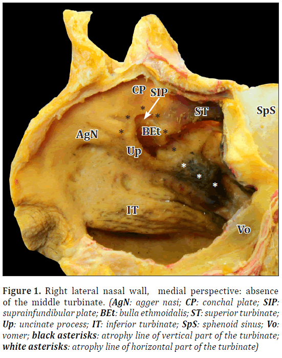 anatomical-variations-maxillary-artery