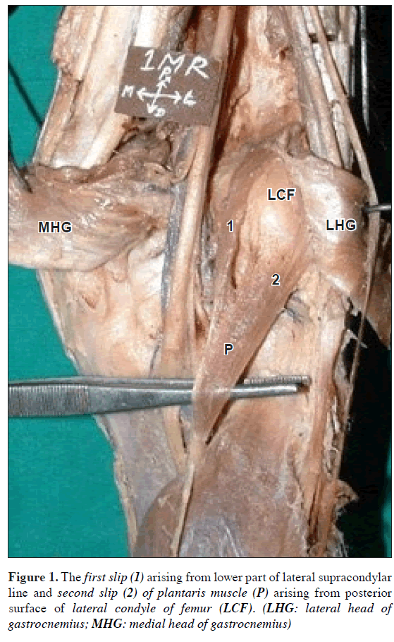 anatomical-variations-lateral-supracondylar