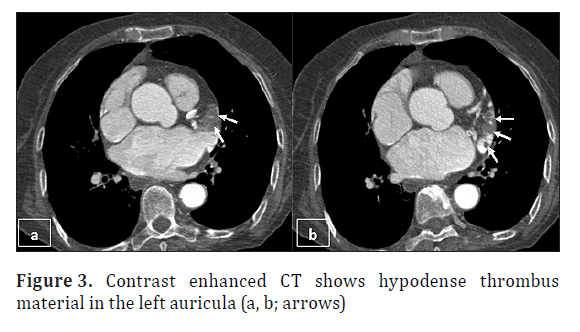 anatomical-variations-left-auricula