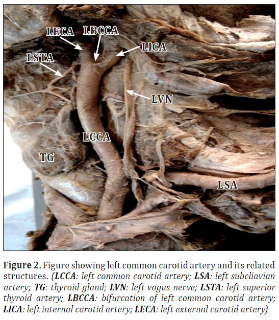 anatomical-variations-left-common-carotid