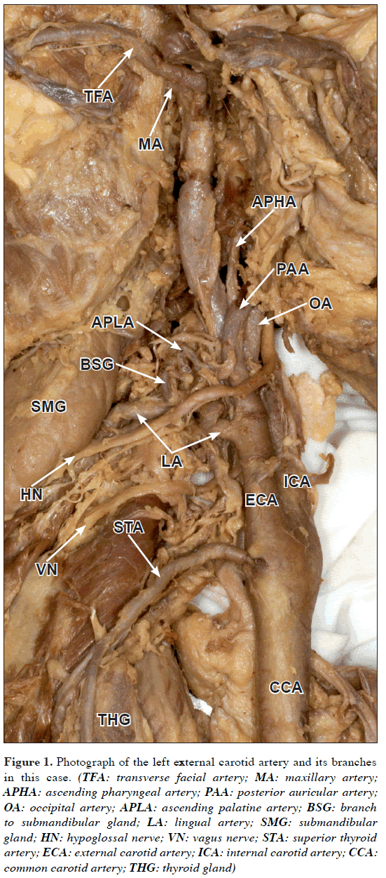 Case of a completely absent facial artery