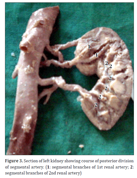 anatomical-variations-left-kidney