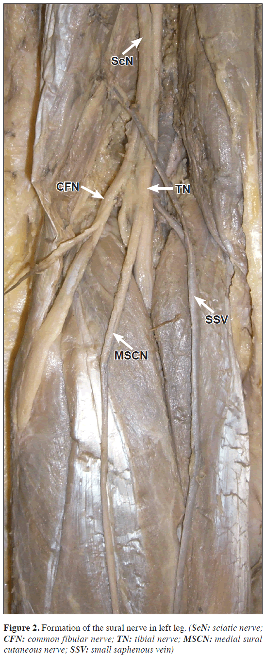 anatomical-variations-left-leg