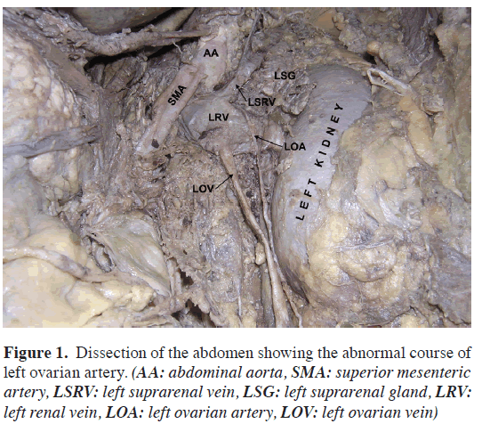 anatomical-variations-left-ovarian-artery