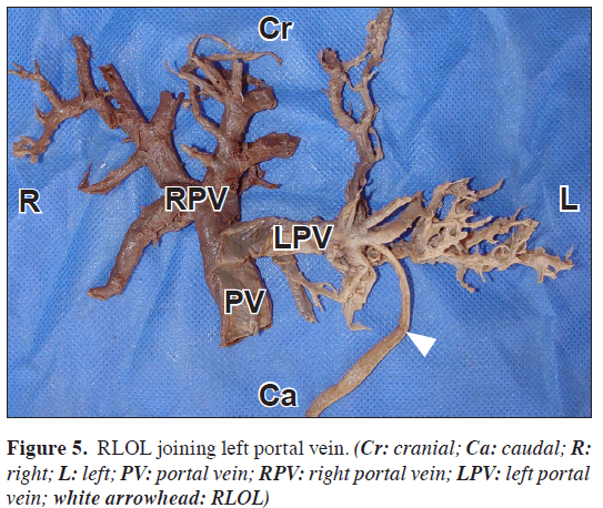 anatomical-variations-left-portal-vein