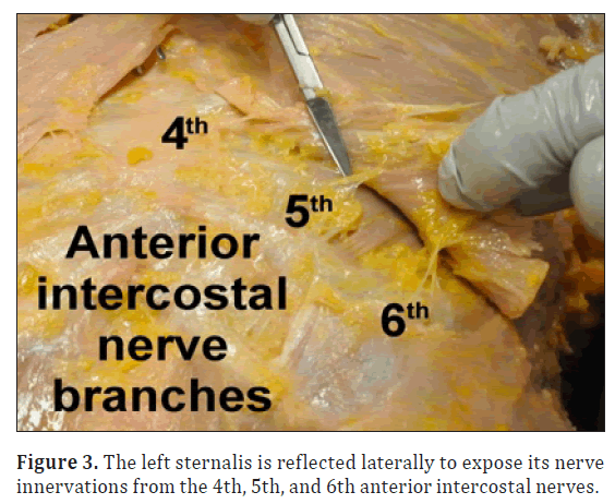 anatomical-variations-left-sternalis