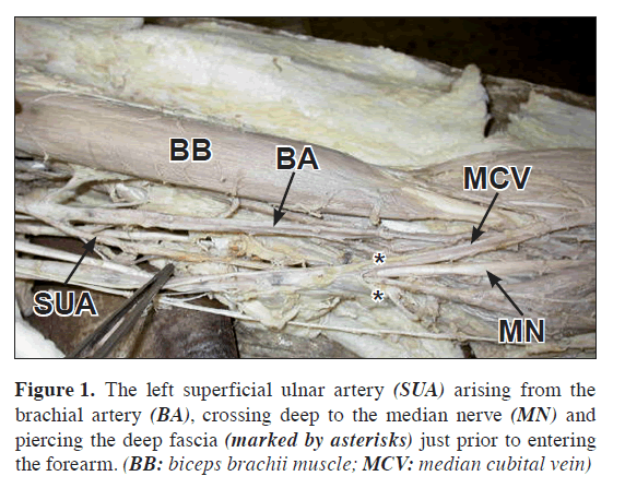 anatomical-variations-left-superficial