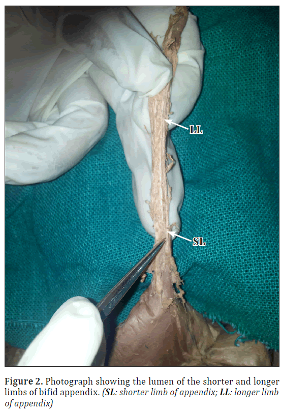anatomical-variations-limb-appendix