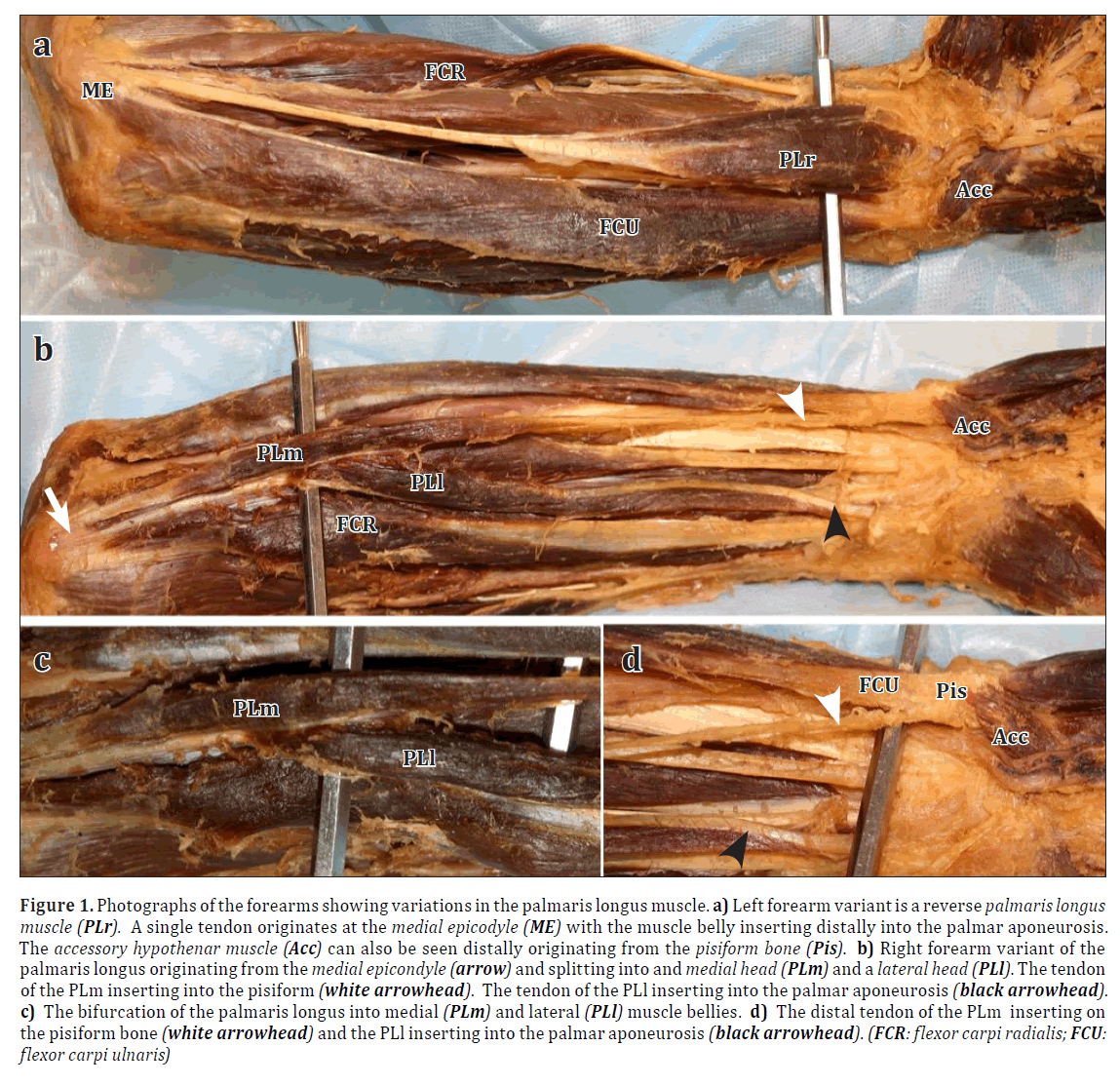 anatomical-variations-longus-muscle