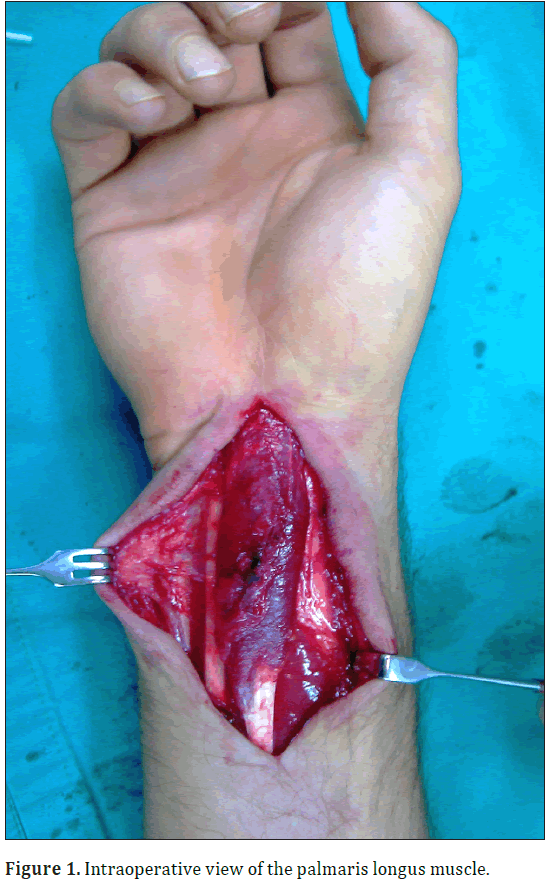 anatomical-variations-longus-muscle