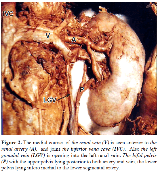 anatomical-variations-lower-kidney