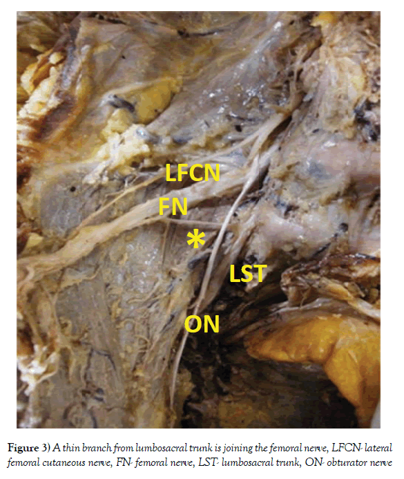 anatomical-variations-lumbosacral-trunk