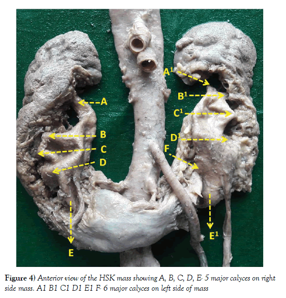 anatomical-variations-major-calyces