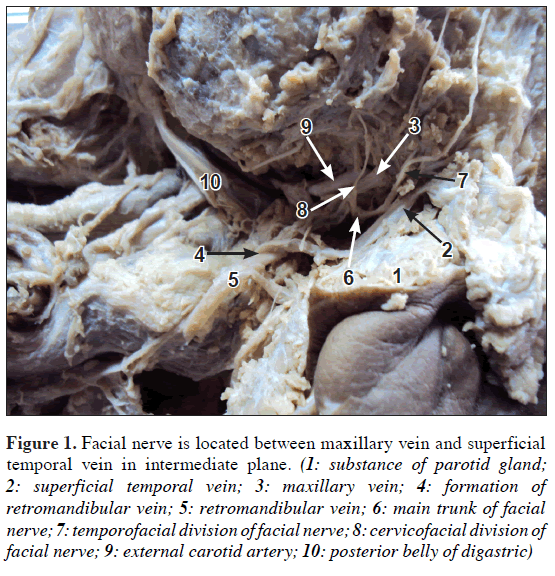 anatomical-variations-maxillary-vein